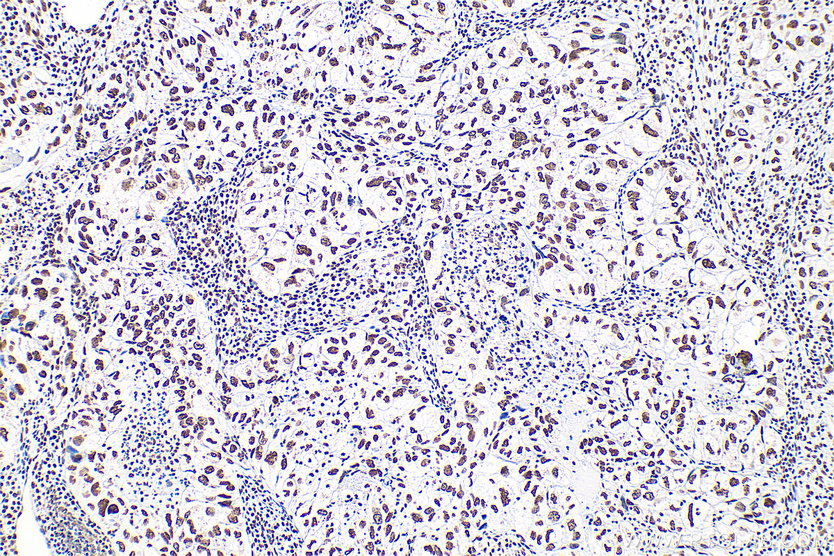 Immunohistochemistry (IHC) staining of human lung cancer tissue using Nucleolin/C23 Recombinant antibody (83380-1-RR)