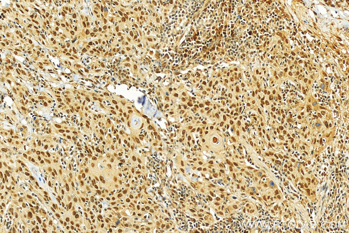 Immunohistochemistry (IHC) staining of human skin cancer tissue using NCOA3 Polyclonal antibody (29587-1-AP)