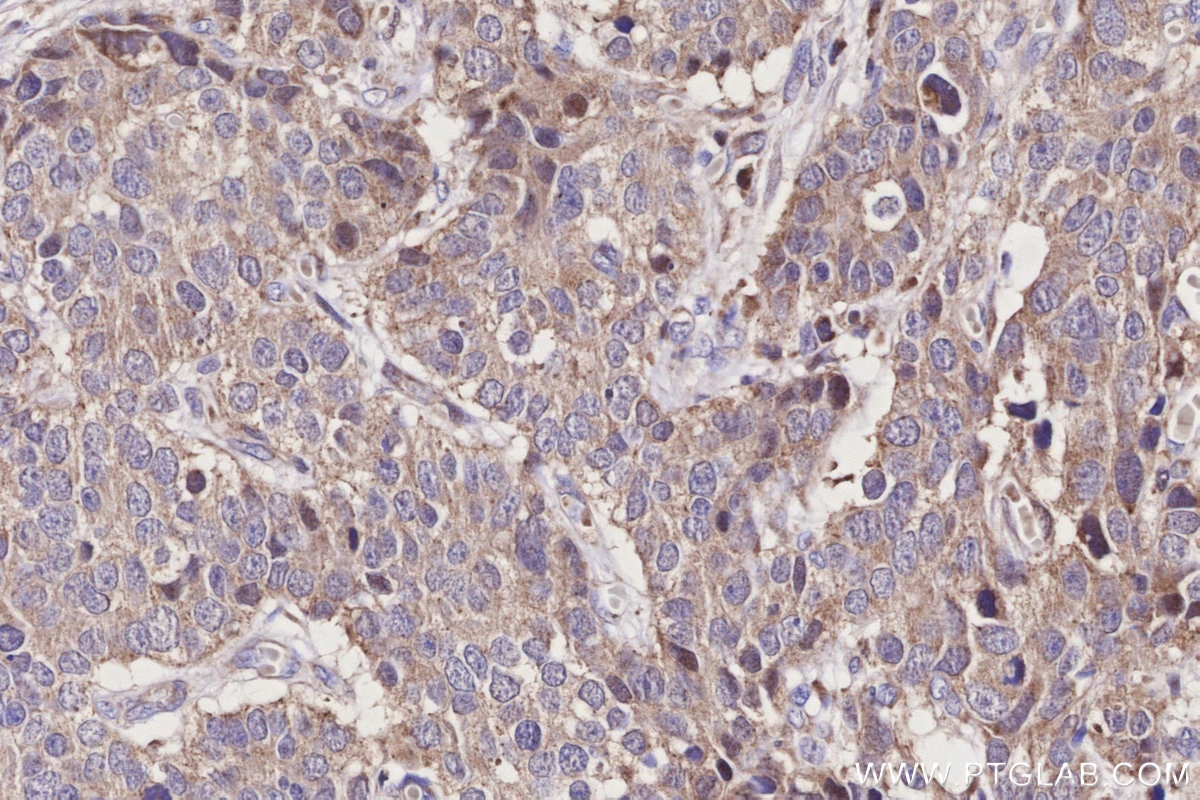 Immunohistochemistry (IHC) staining of human stomach cancer tissue using ND1 Polyclonal antibody (19703-1-AP)