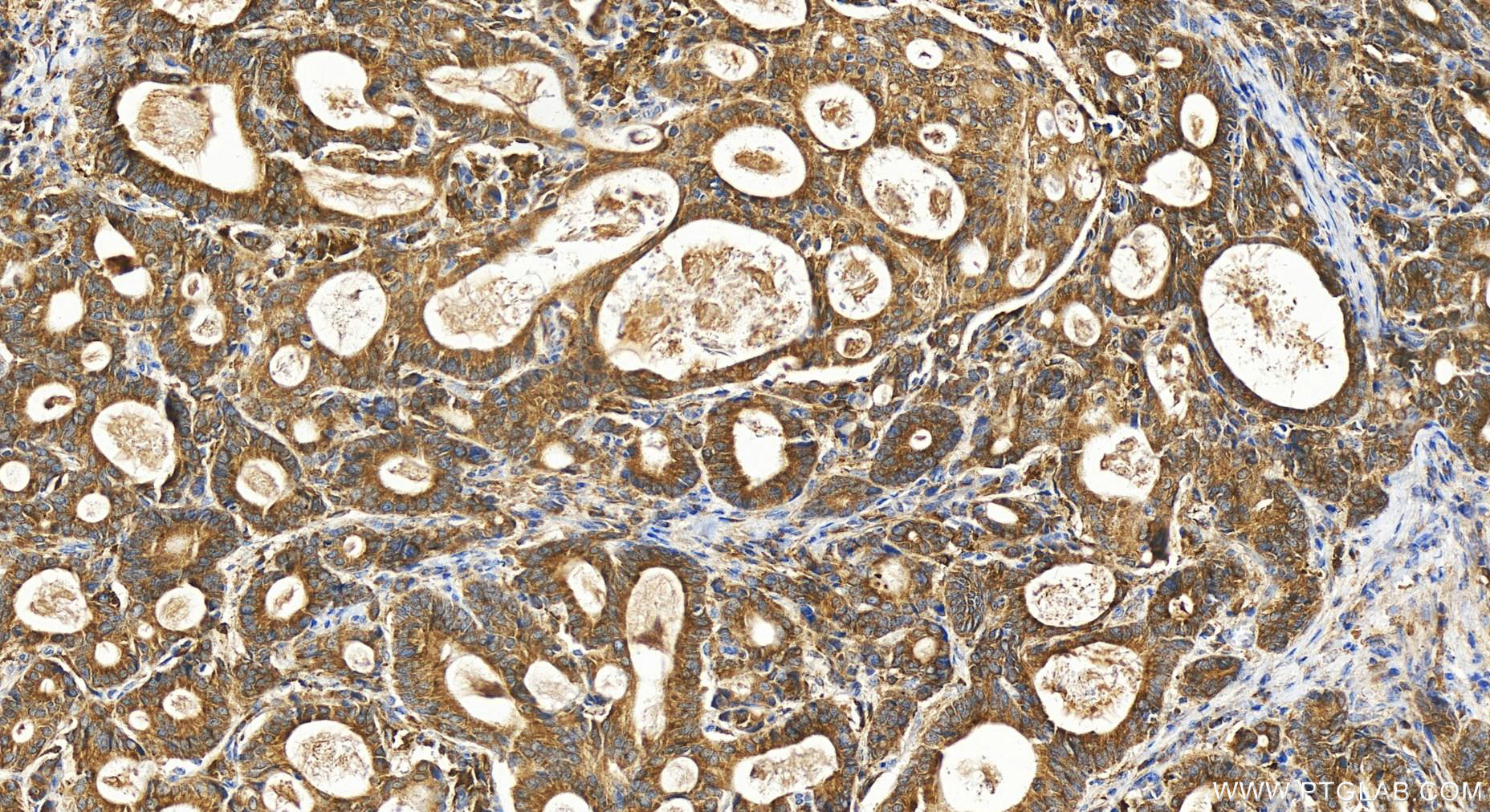 Immunohistochemistry (IHC) staining of human stomach cancer tissue using ND2 Polyclonal antibody (19704-1-AP)