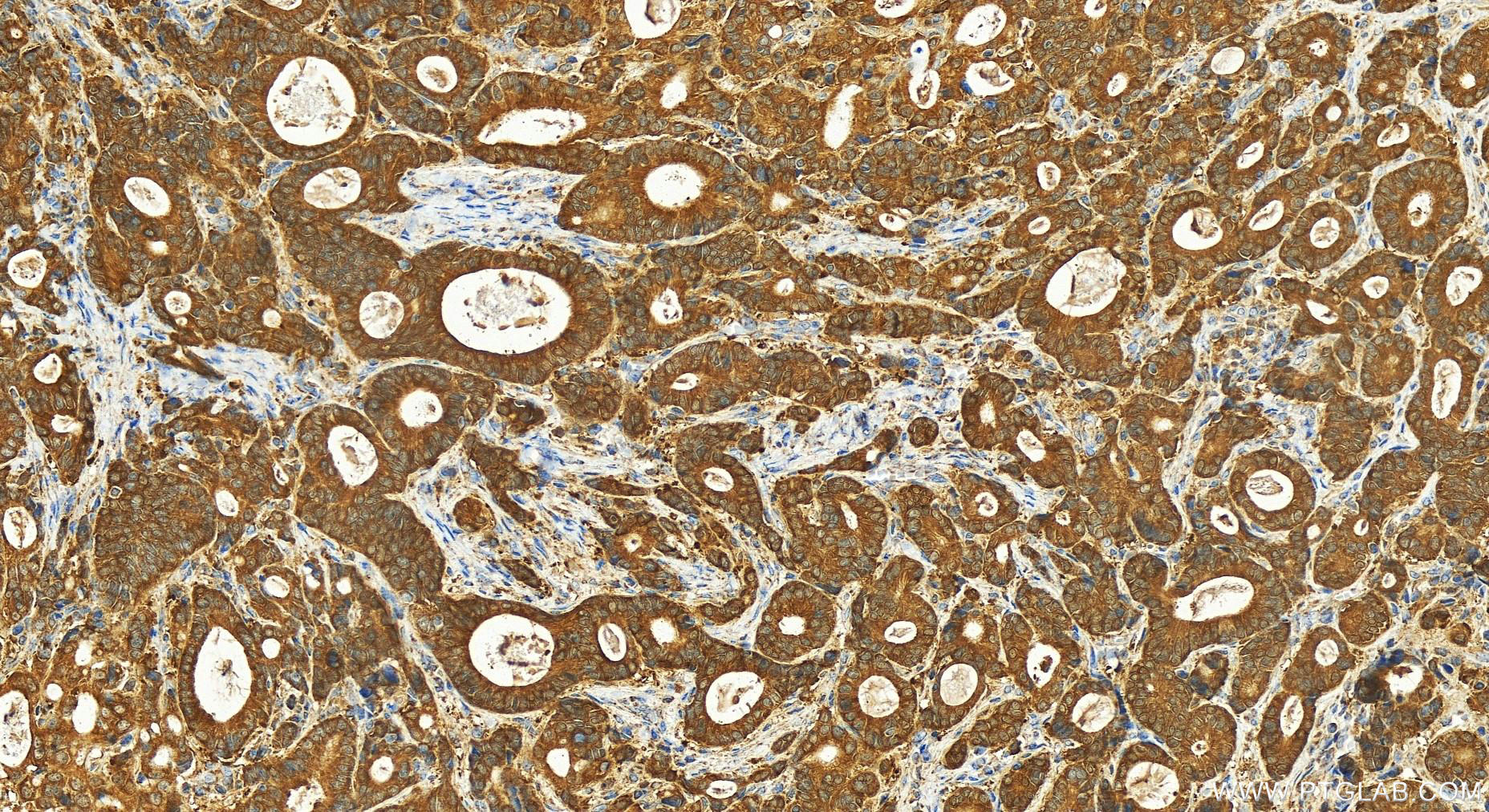 Immunohistochemistry (IHC) staining of human stomach cancer tissue using NDUFA8 Polyclonal antibody (15064-1-AP)