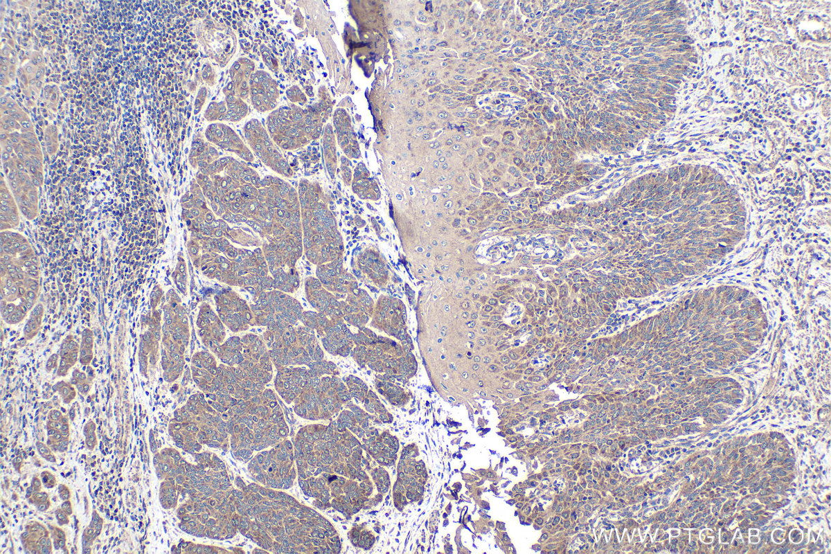 Immunohistochemistry (IHC) staining of human oesophagus cancer tissue using NDUFAF1 Polyclonal antibody (15181-1-AP)