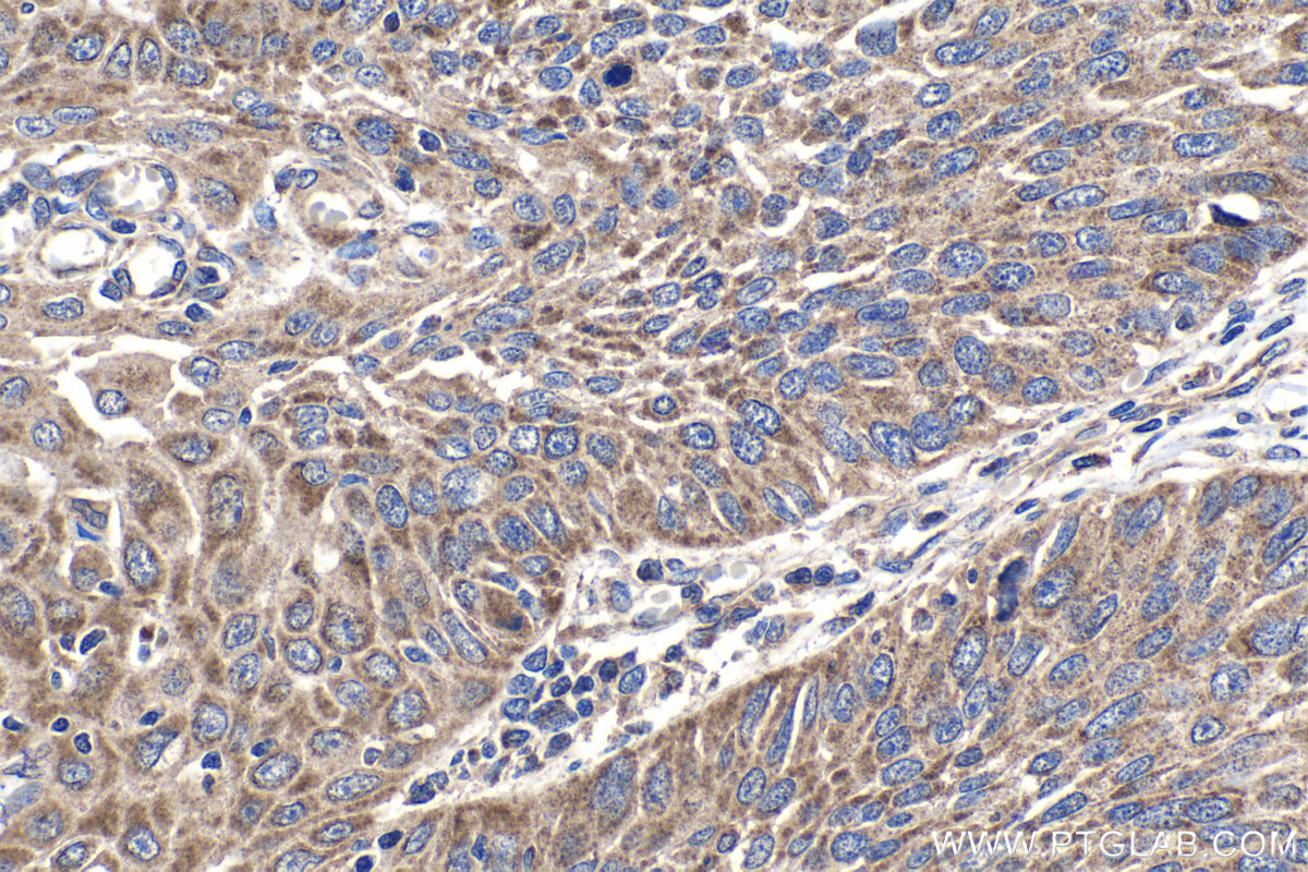 Immunohistochemistry (IHC) staining of human oesophagus cancer tissue using NDUFAF1 Polyclonal antibody (15181-1-AP)