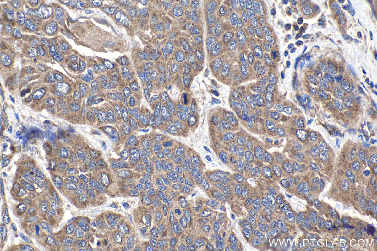 Immunohistochemistry (IHC) staining of human oesophagus cancer tissue using NDUFAF1 Polyclonal antibody (15181-1-AP)