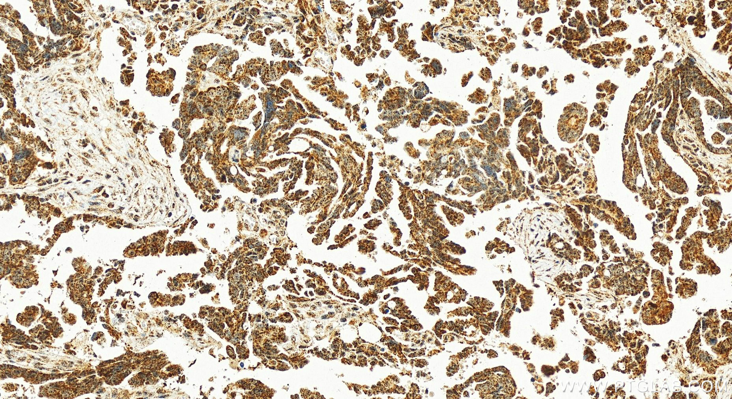 Immunohistochemistry (IHC) staining of human ovary cancer tissue using NDUFB10 Polyclonal antibody (15589-1-AP)