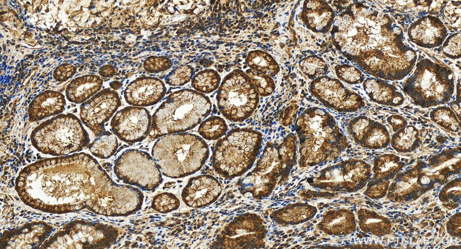 Immunohistochemistry (IHC) staining of human stomach cancer tissue using NDUFB4 Polyclonal antibody (27931-1-AP)