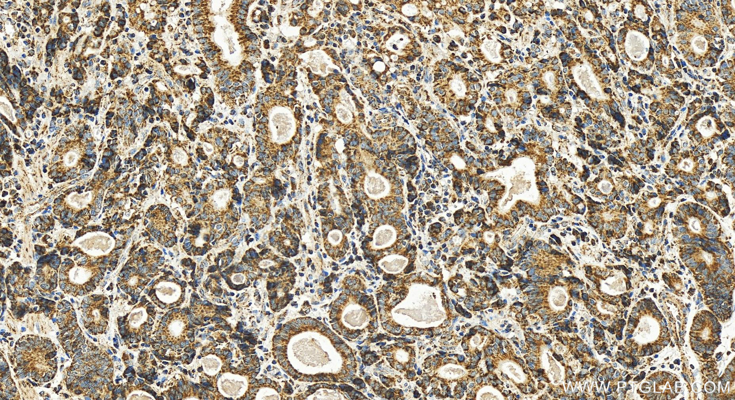 Immunohistochemistry (IHC) staining of human stomach cancer tissue using NDUFB8 Recombinant antibody (83216-3-RR)