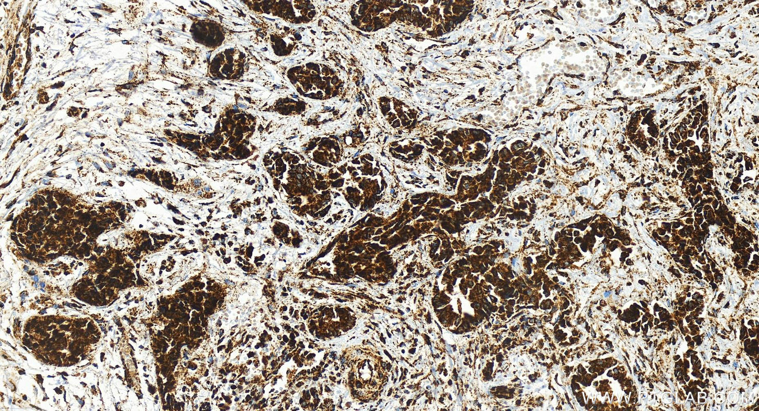 Immunohistochemistry (IHC) staining of human intrahepatic cholangiocarcinoma tissue using NDUFB8 Recombinant antibody (83216-3-RR)