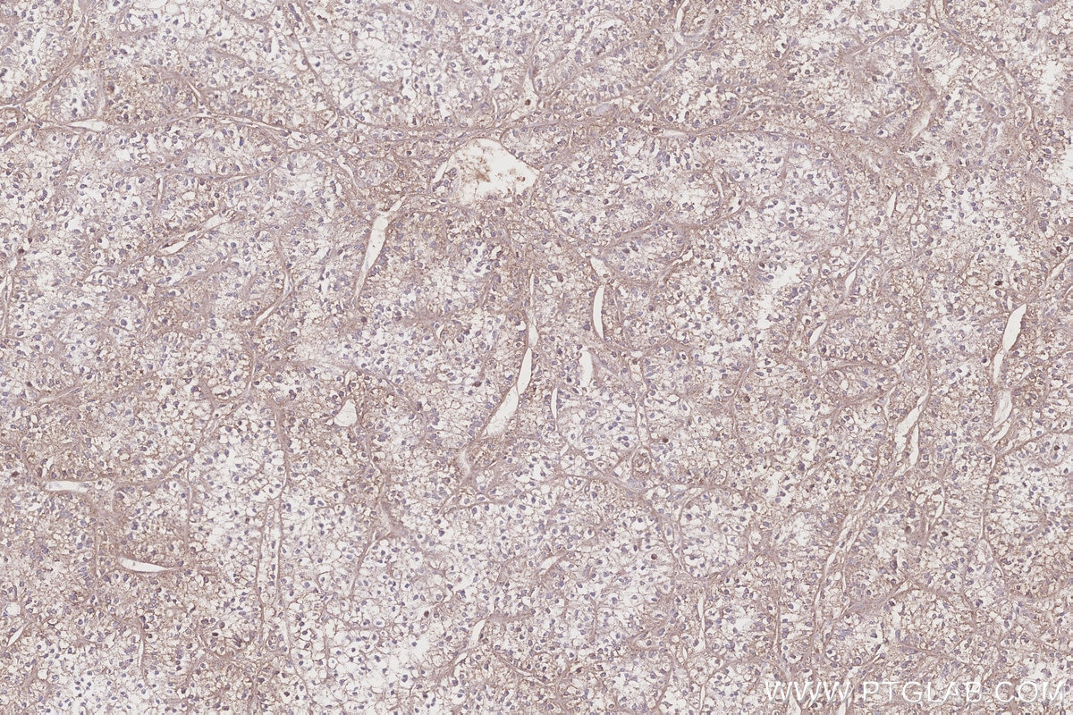 Immunohistochemistry (IHC) staining of human renal cell carcinoma tissue using NDUFS7 Polyclonal antibody (15728-1-AP)
