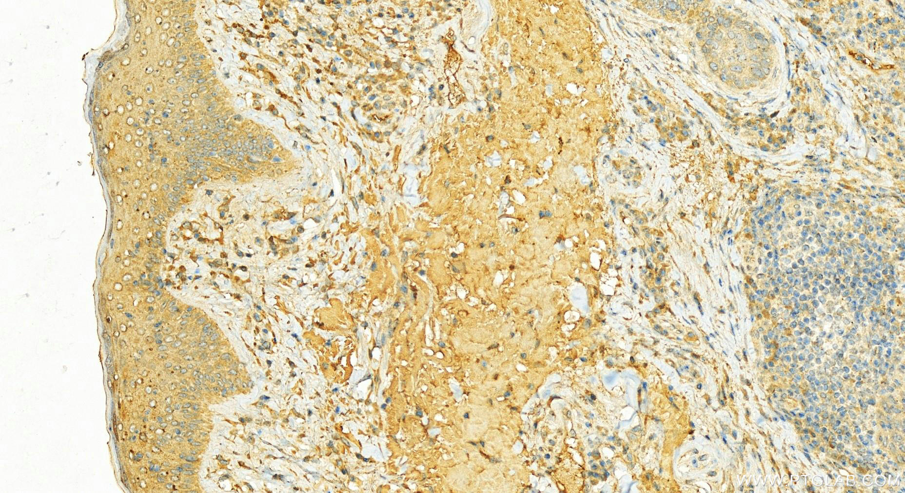 Immunohistochemistry (IHC) staining of human skin cancer tissue using NEK2 Polyclonal antibody (14233-1-AP)