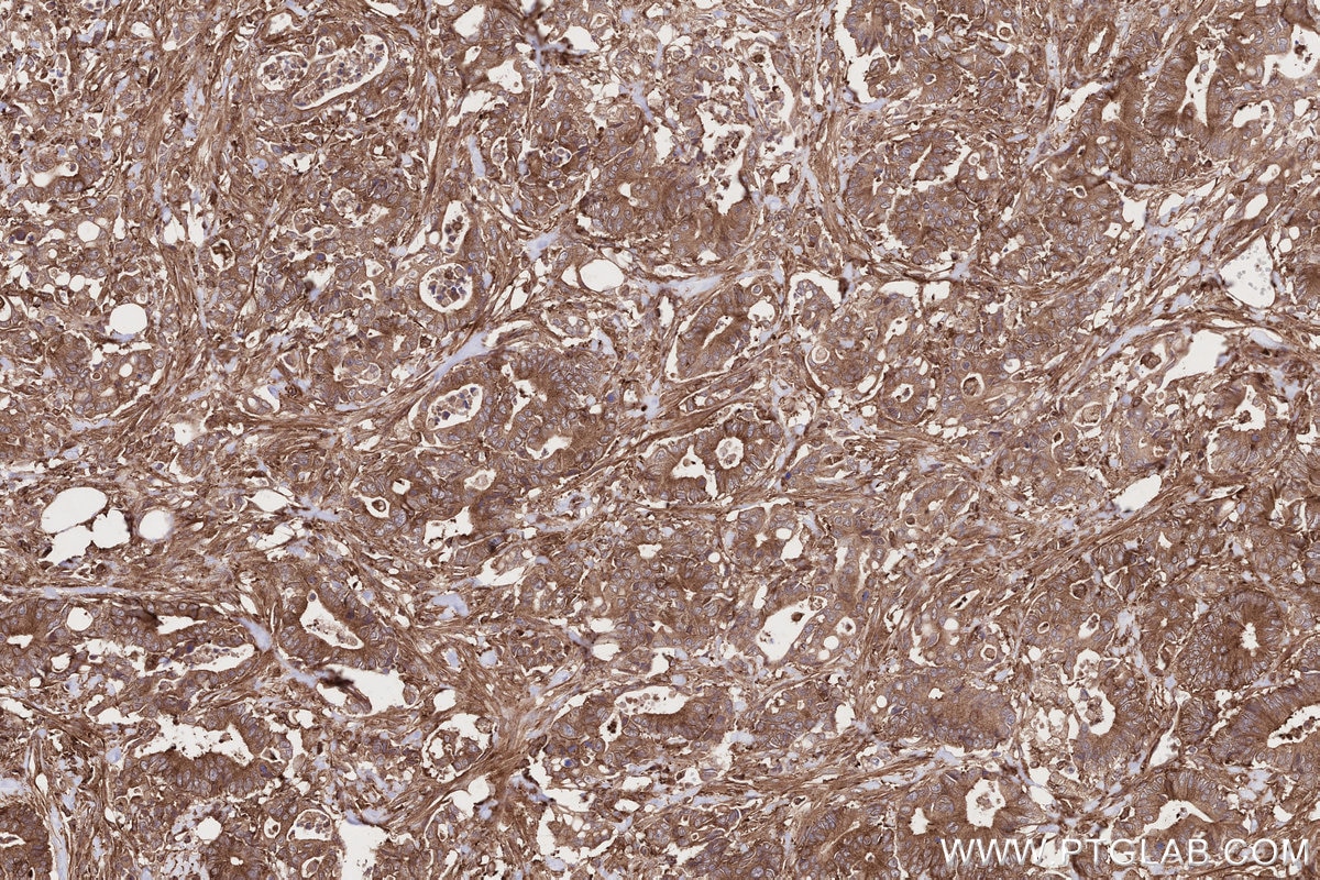 Immunohistochemistry (IHC) staining of human rectal cancer tissue using NEK9 Polyclonal antibody (11192-1-AP)
