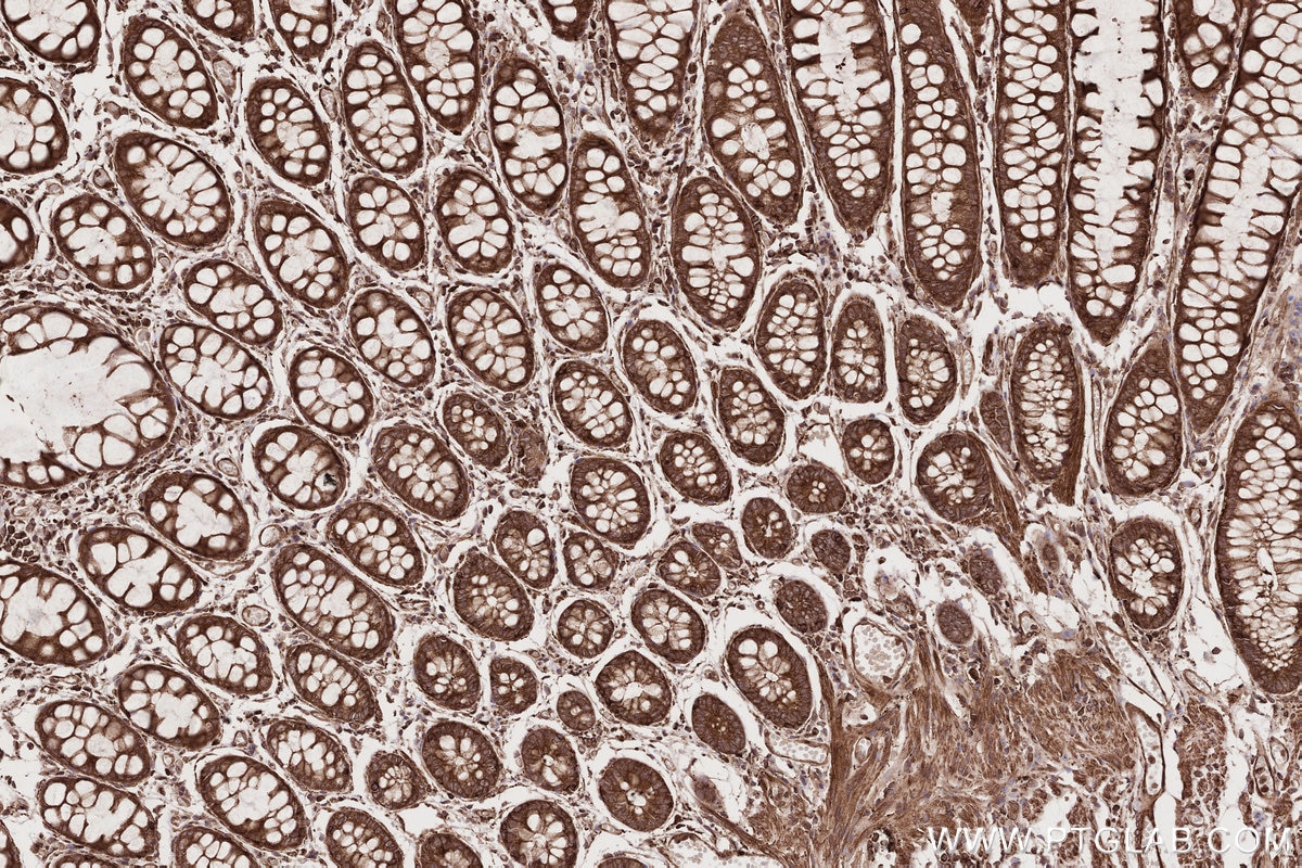 Immunohistochemistry (IHC) staining of human rectal cancer tissue using NEK9 Polyclonal antibody (11192-1-AP)