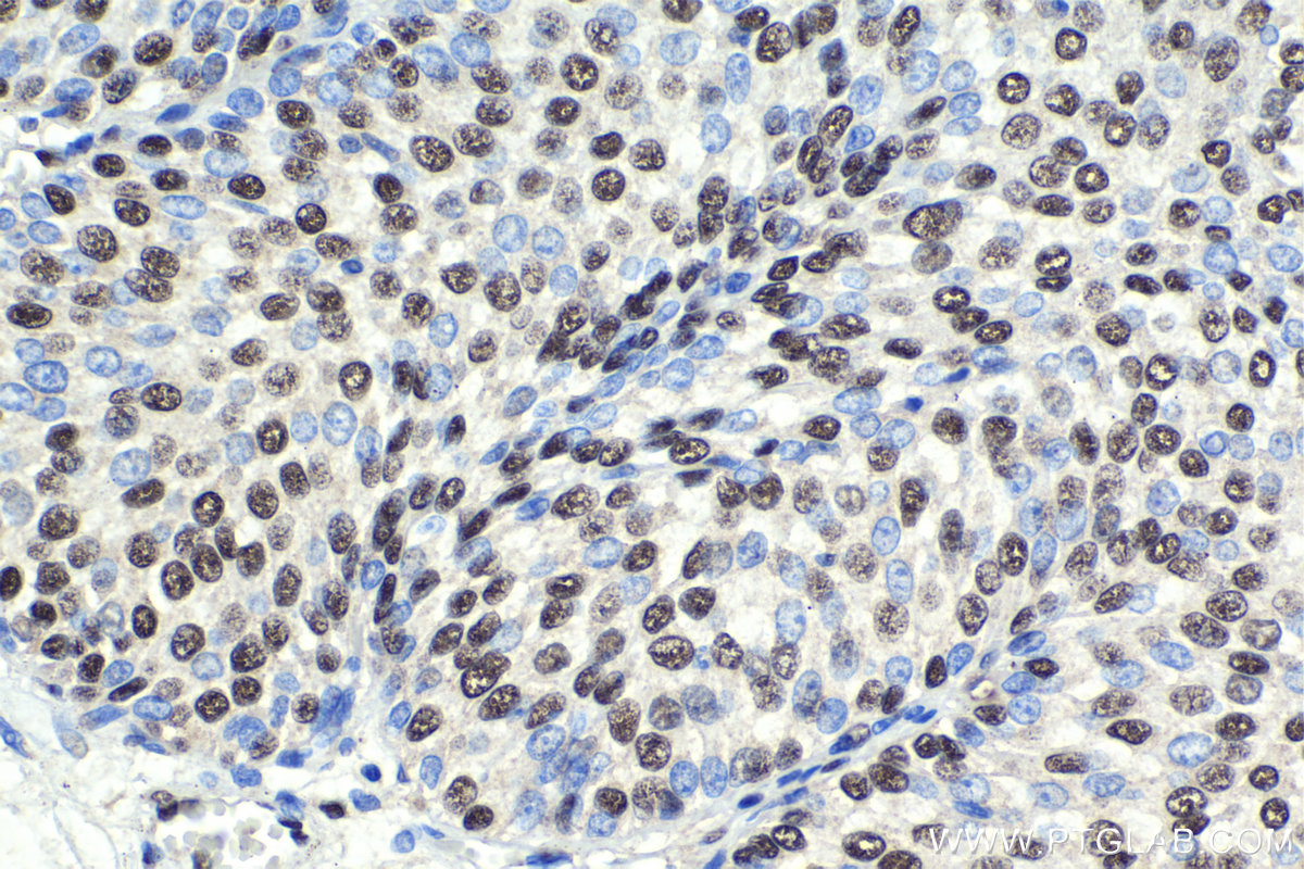 Immunohistochemistry (IHC) staining of human urothelial carcinoma tissue using NELFB Polyclonal antibody (16418-1-AP)