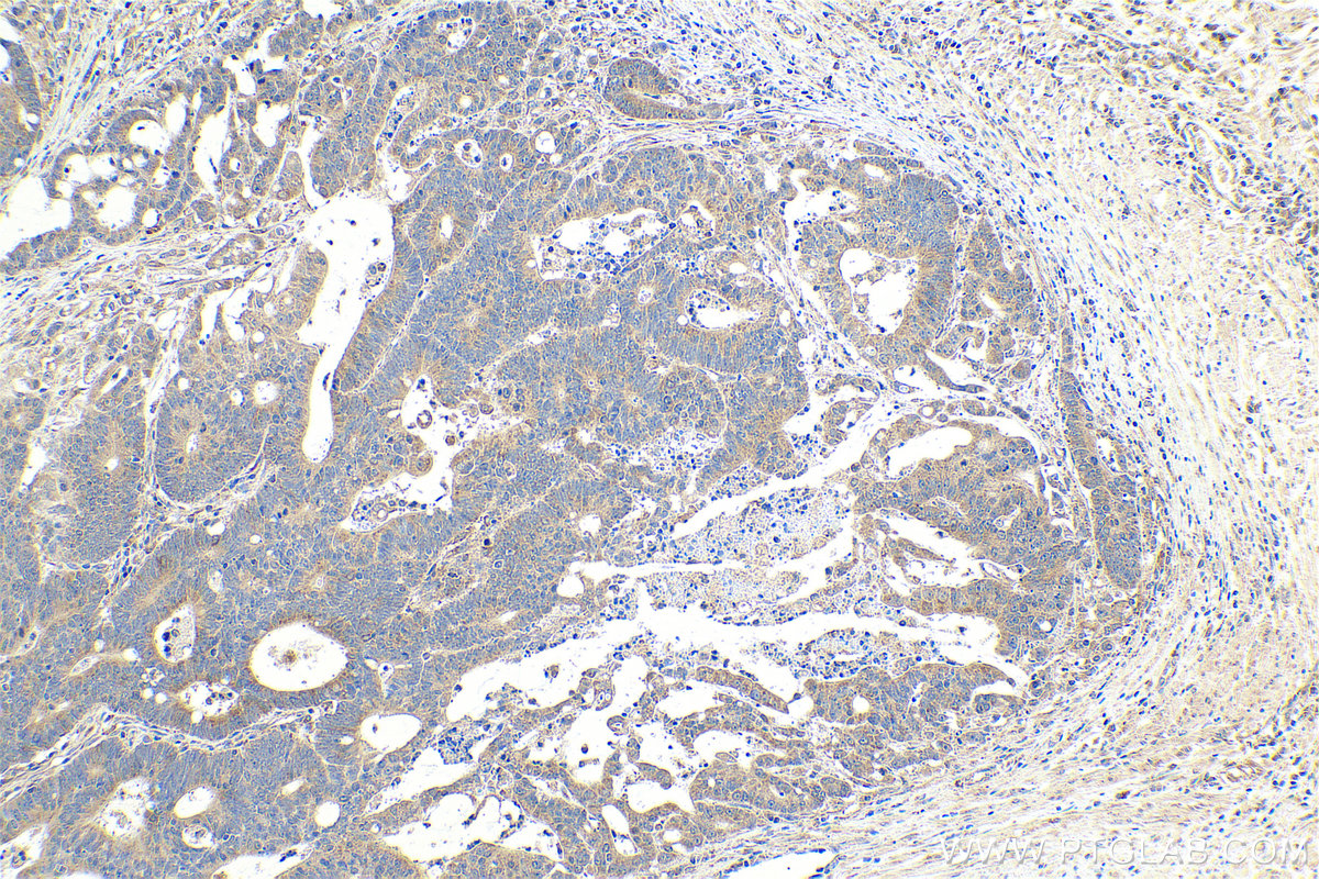 Immunohistochemistry (IHC) staining of human colon cancer tissue using Neudesin/NENF Monoclonal antibody (60131-1-Ig)