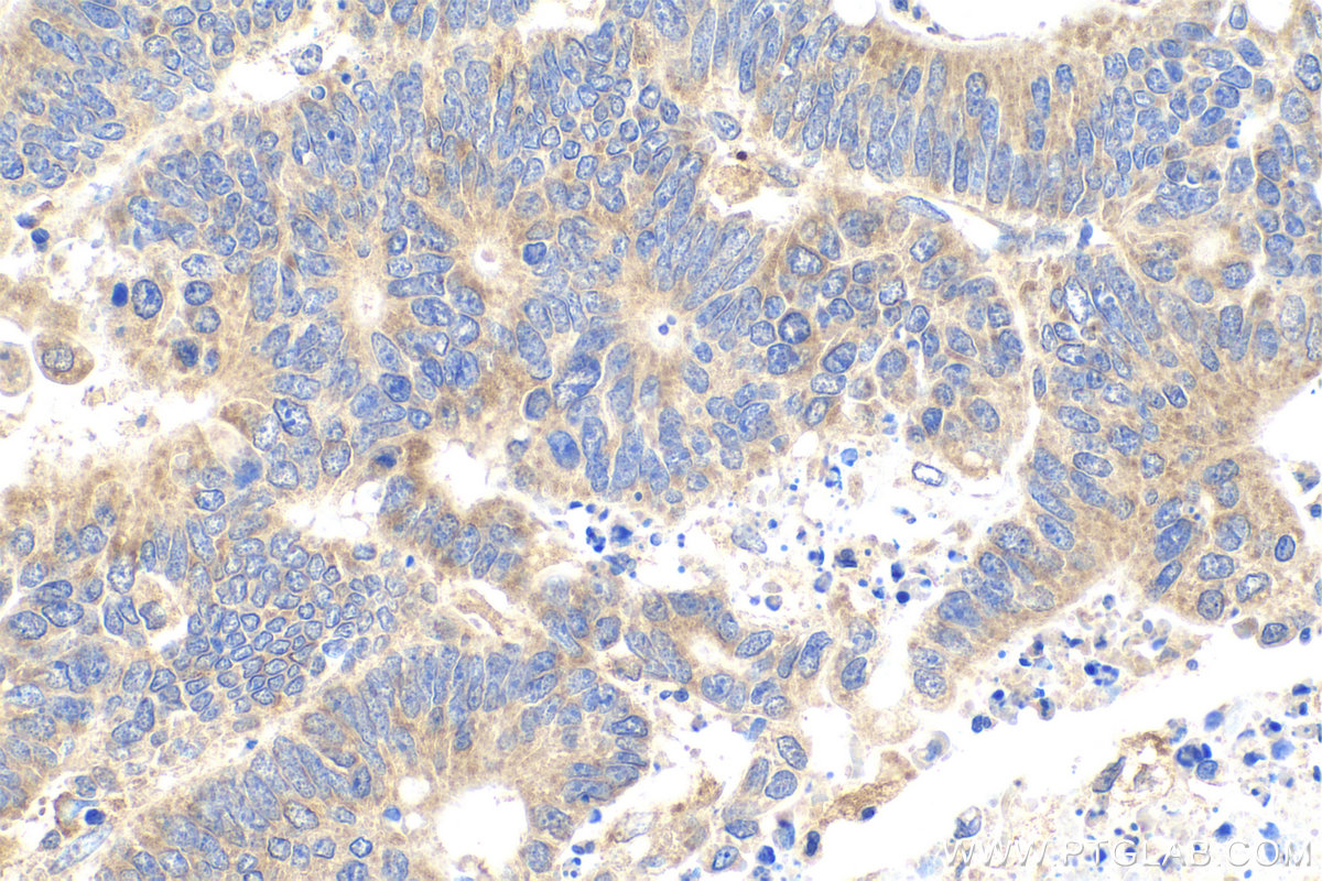 Immunohistochemistry (IHC) staining of human colon cancer tissue using Neudesin/NENF Monoclonal antibody (60131-1-Ig)