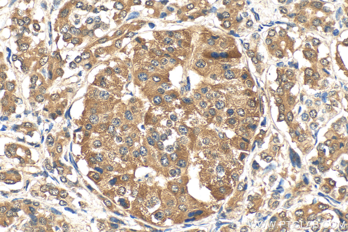 Immunohistochemistry (IHC) staining of human pancreas cancer tissue using NRF2, NFE2L2 Polyclonal antibody (16396-1-AP)