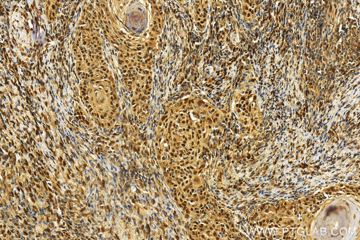 Immunohistochemistry (IHC) staining of human skin cancer tissue using NFIB Polyclonal antibody (29898-1-AP)