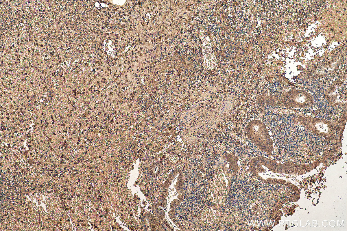 Immunohistochemistry (IHC) staining of human appendicitis tissue using NFKB1,p105,p50 Monoclonal antibody (66992-1-Ig)