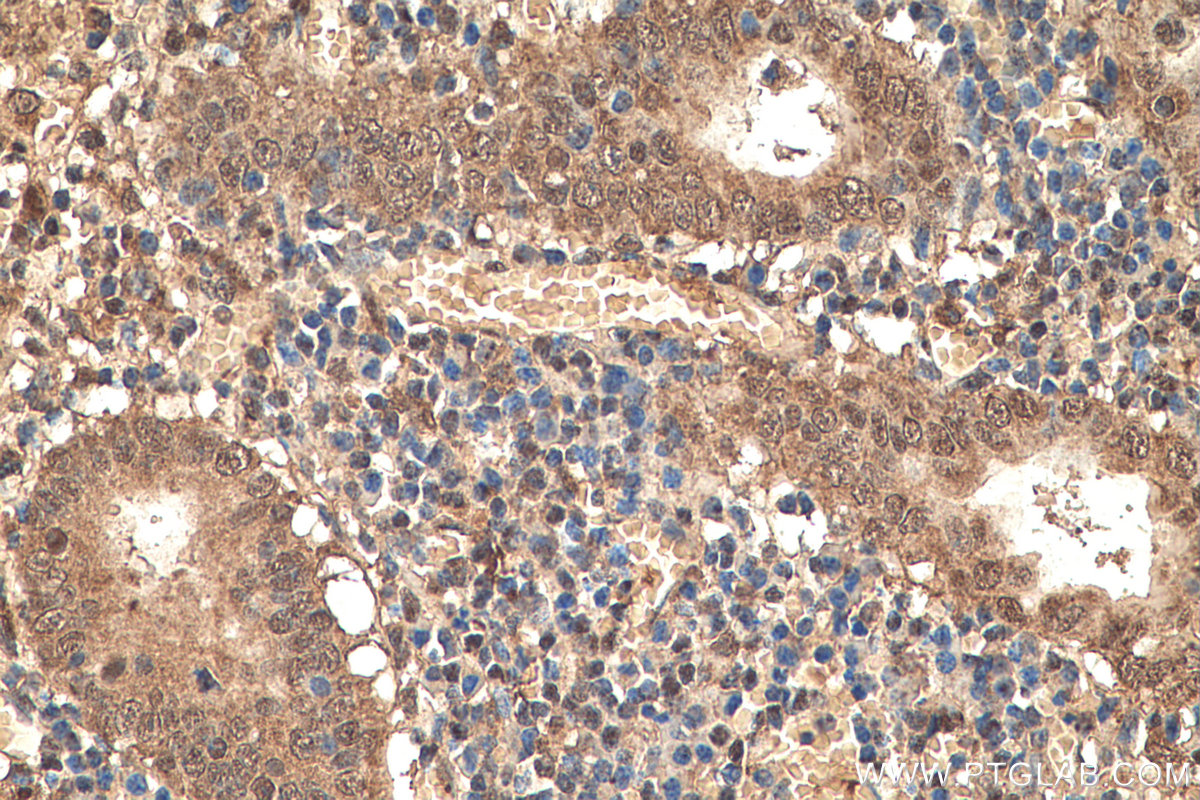 Immunohistochemistry (IHC) staining of human appendicitis tissue using NFKB1,p105,p50 Monoclonal antibody (66992-1-Ig)