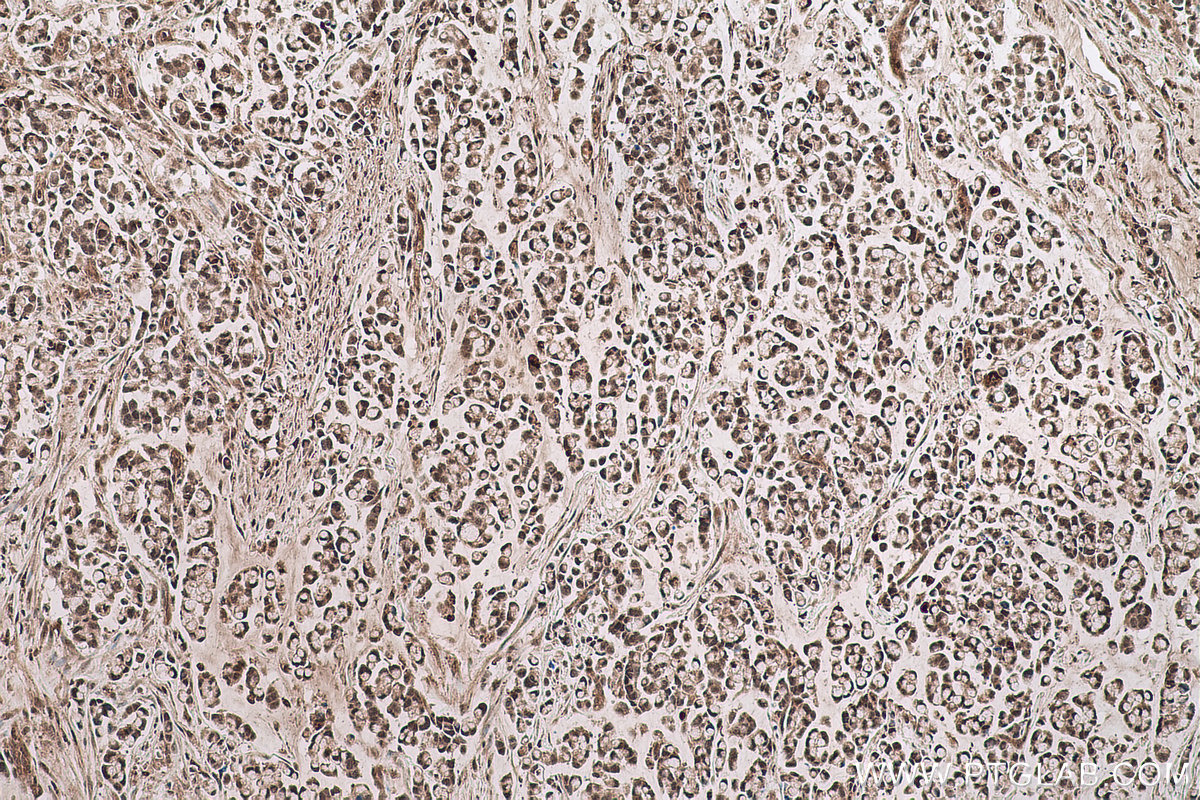 Immunohistochemistry (IHC) staining of human colon cancer tissue using NFKB1,p105,p50 Monoclonal antibody (66992-1-Ig)