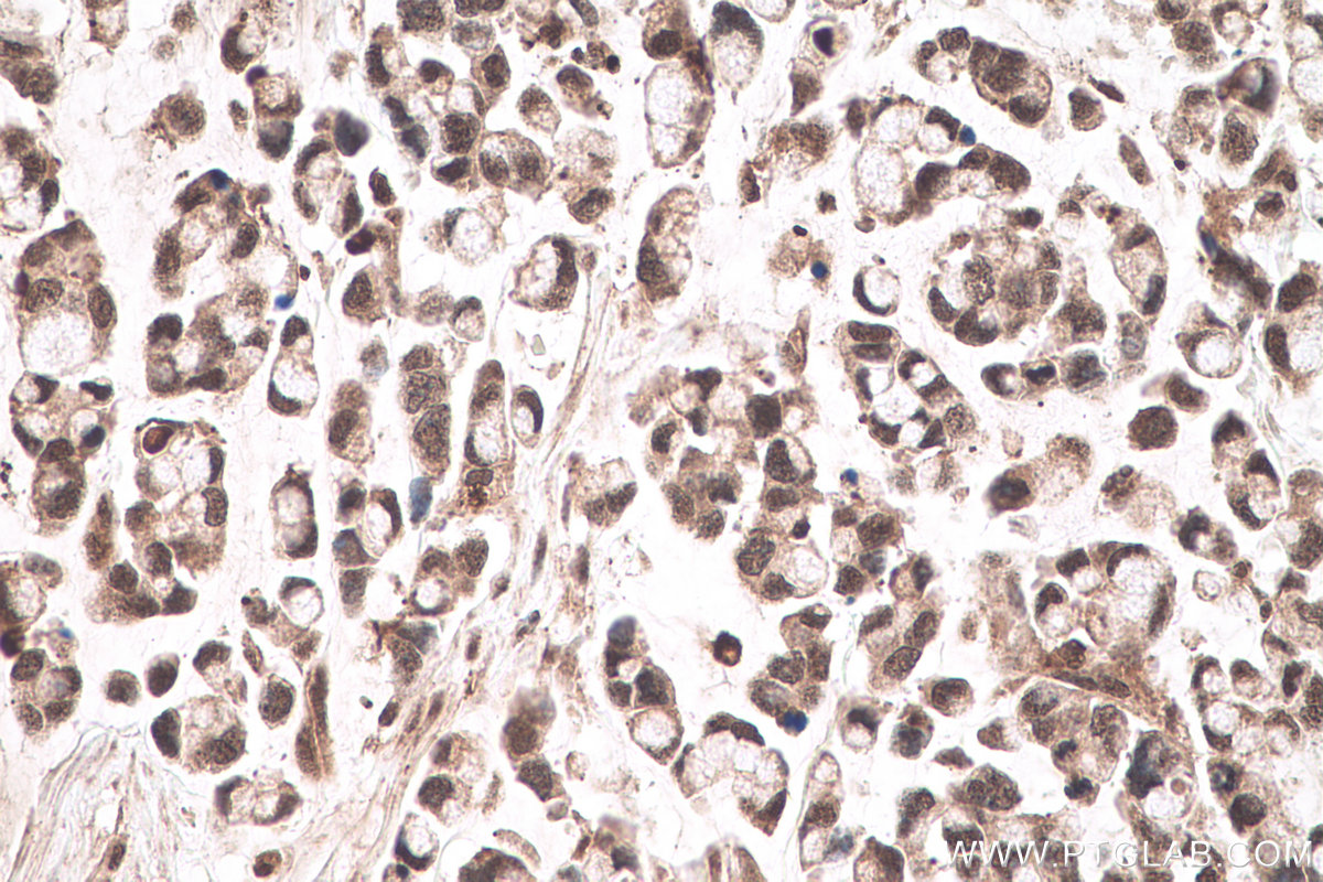 Immunohistochemistry (IHC) staining of human colon cancer tissue using NFKB1,p105,p50 Monoclonal antibody (66992-1-Ig)