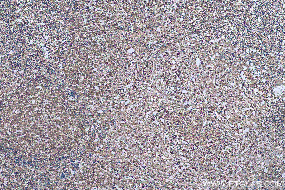 Immunohistochemistry (IHC) staining of human lymphoma tissue using NFKB1,p105,p50 Monoclonal antibody (66992-1-Ig)