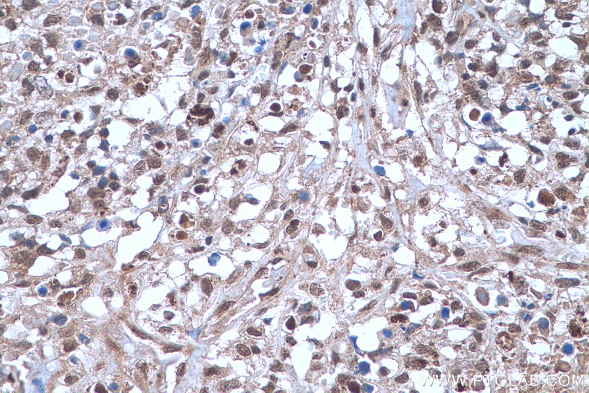 Immunohistochemistry (IHC) staining of human lymphoma tissue using NFKB1,p105,p50 Monoclonal antibody (66992-1-Ig)