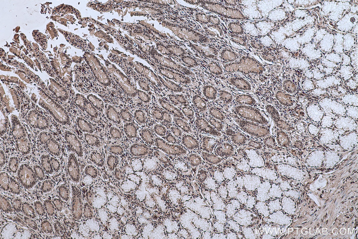 Immunohistochemistry (IHC) staining of human stomach cancer tissue using NFKB1,p105,p50 Monoclonal antibody (66992-1-Ig)