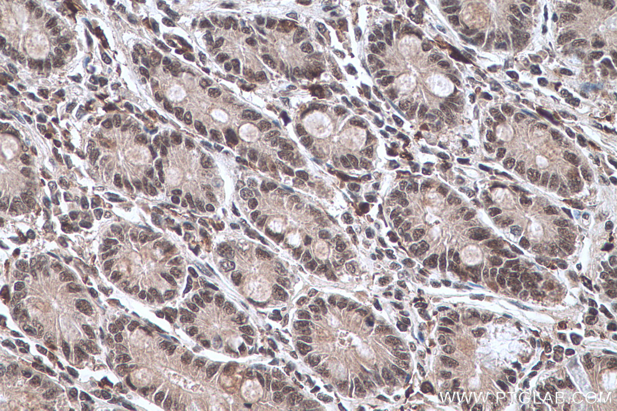 Immunohistochemistry (IHC) staining of human stomach cancer tissue using NFKB1,p105,p50 Monoclonal antibody (66992-1-Ig)