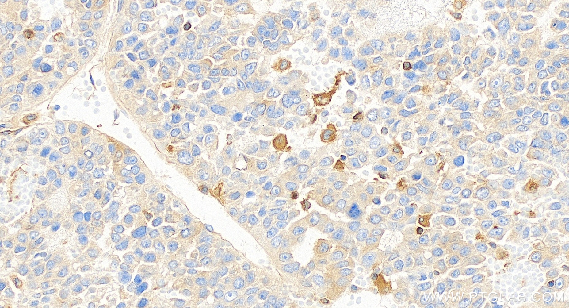 Immunohistochemistry (IHC) staining of human liver cancer tissue using NFKB2,p100 Recombinant antibody (84022-6-RR)
