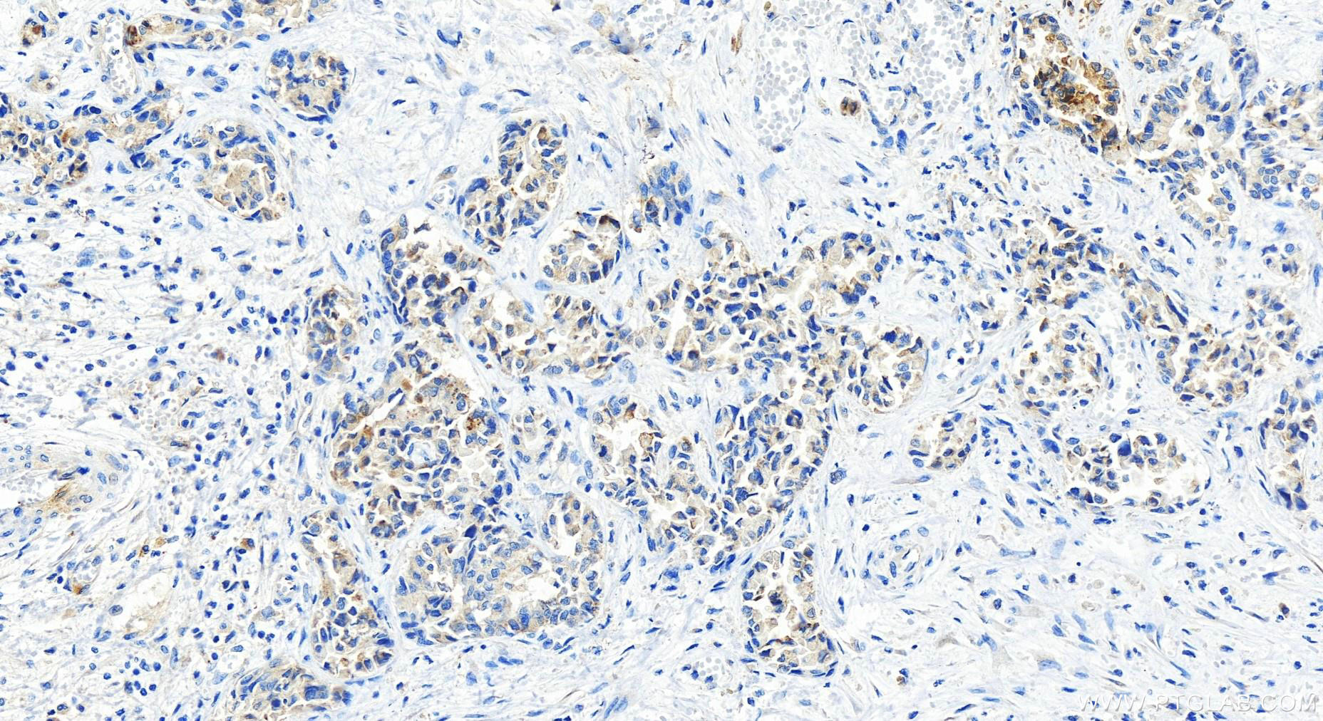 Immunohistochemistry (IHC) staining of human intrahepatic cholangiocarcinoma tissue using NGAL Recombinant antibody (82841-1-RR)