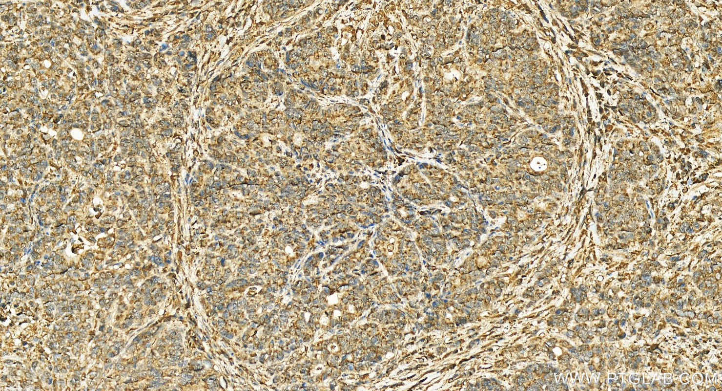 Immunohistochemistry (IHC) staining of human stomach cancer tissue using NGFRAP1 Polyclonal antibody (10446-1-AP)