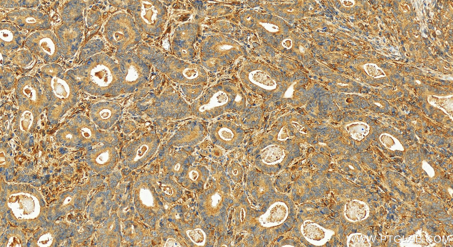 Immunohistochemistry (IHC) staining of human stomach cancer tissue using Entactin Polyclonal antibody (13766-1-AP)