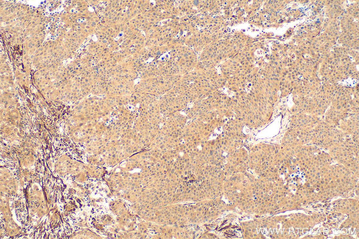Immunohistochemistry (IHC) staining of human lung cancer tissue using NLRC5 Polyclonal antibody (31067-1-AP)