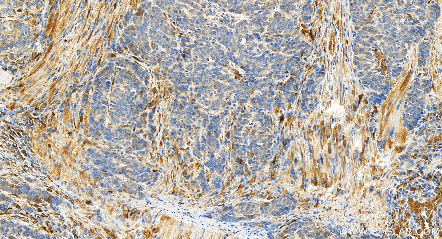 Immunohistochemistry (IHC) staining of human stomach cancer tissue using NNMT Polyclonal antibody (15123-1-AP)