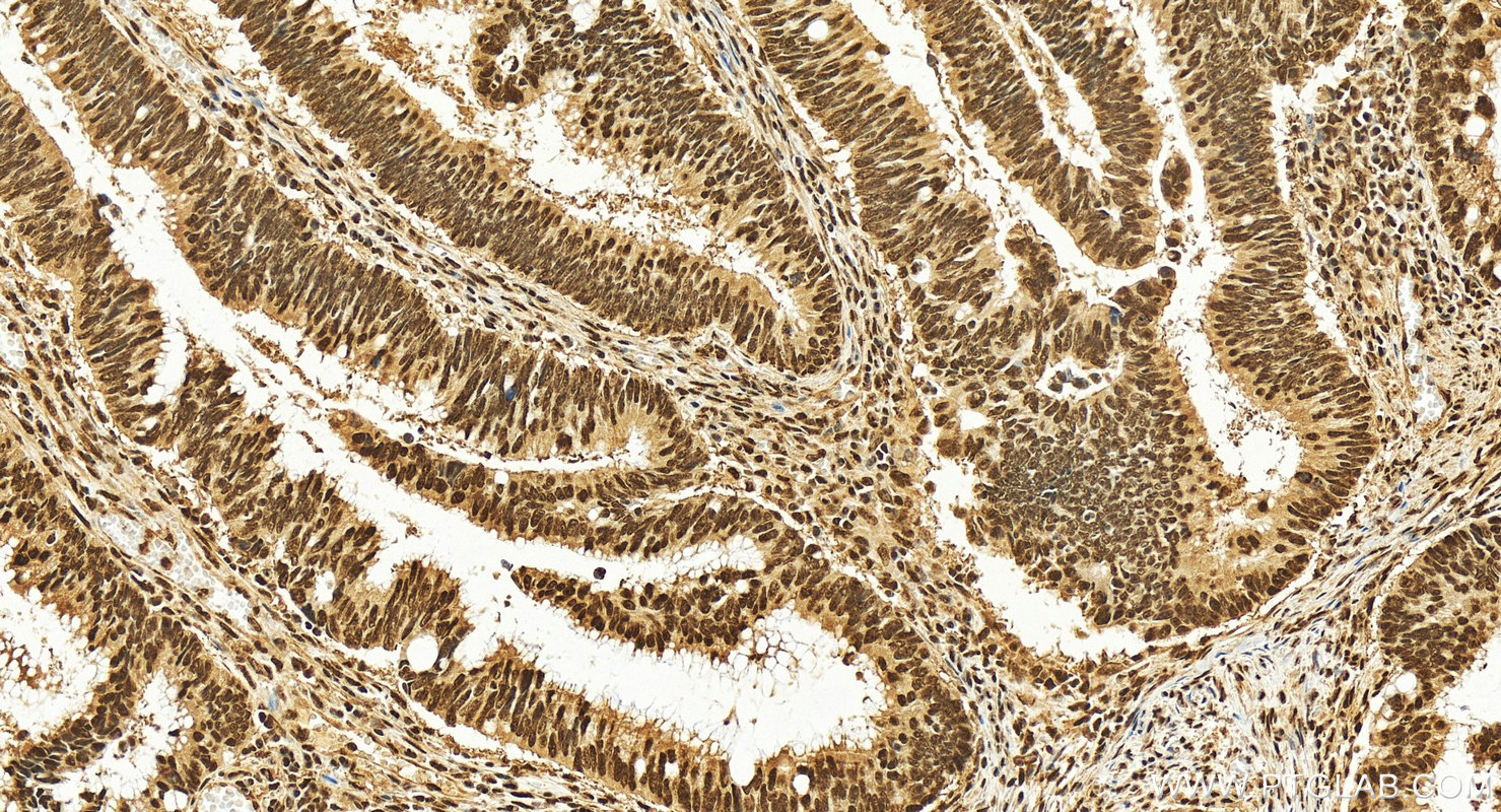 Immunohistochemistry (IHC) staining of human colon cancer tissue using NONO Polyclonal antibody (11058-1-AP)