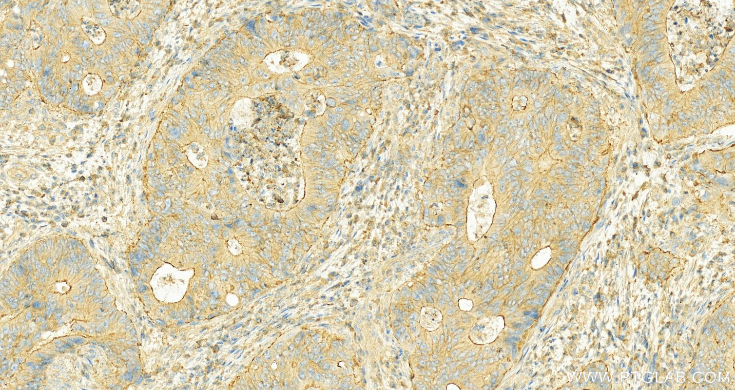 Immunohistochemistry (IHC) staining of Human colon cancer tissue using NOX1 Polyclonal antibody (17772-1-AP)