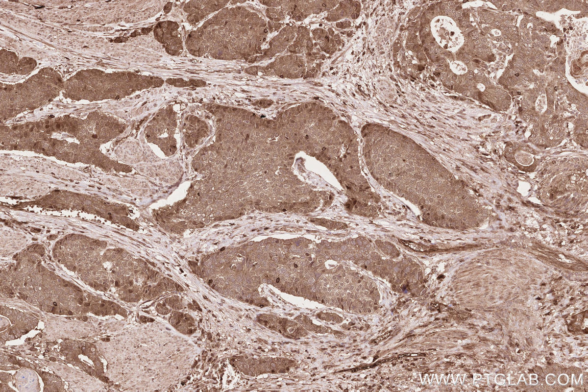 Immunohistochemistry (IHC) staining of human stomach cancer tissue using NPHP3 Polyclonal antibody (22026-1-AP)