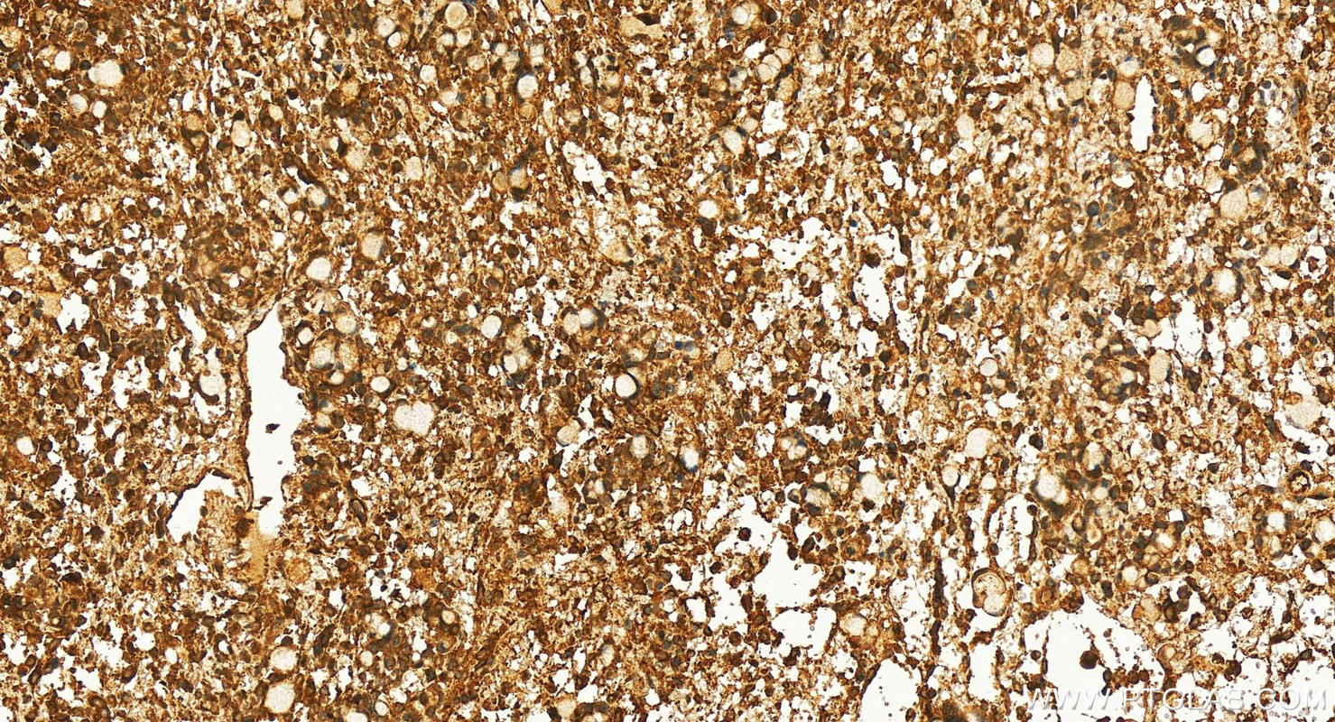 Immunohistochemistry (IHC) staining of human ovary cancer tissue using NPL Polyclonal antibody (16715-1-AP)