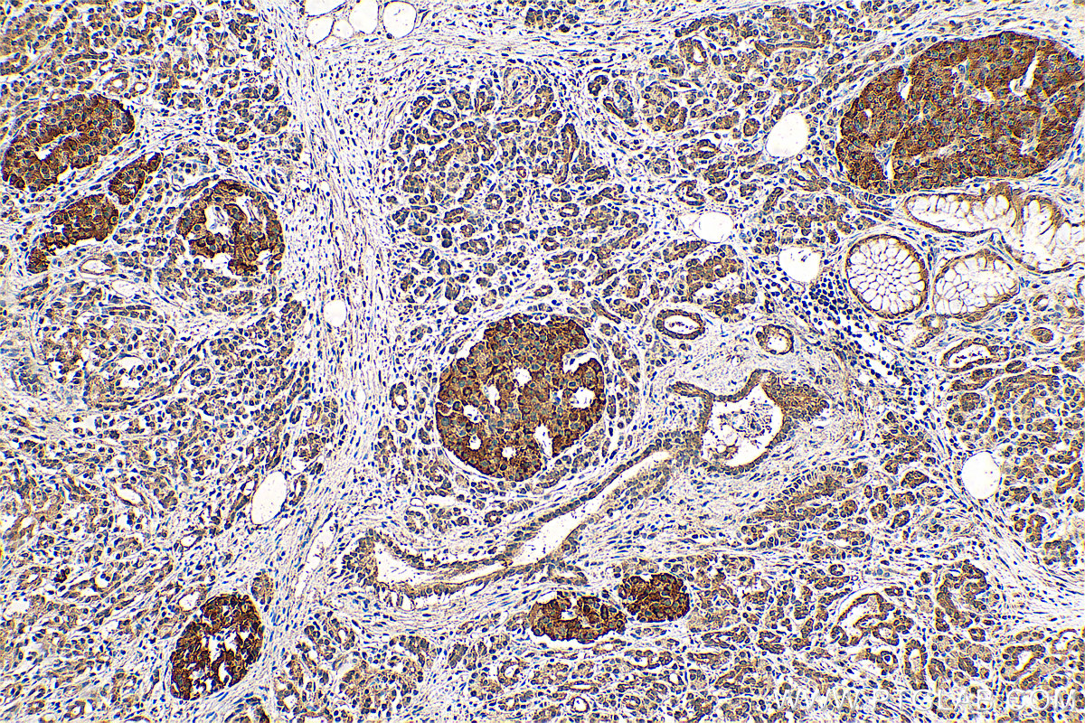 Immunohistochemistry (IHC) staining of human pancreas cancer tissue using NPS Polyclonal antibody (23609-1-AP)