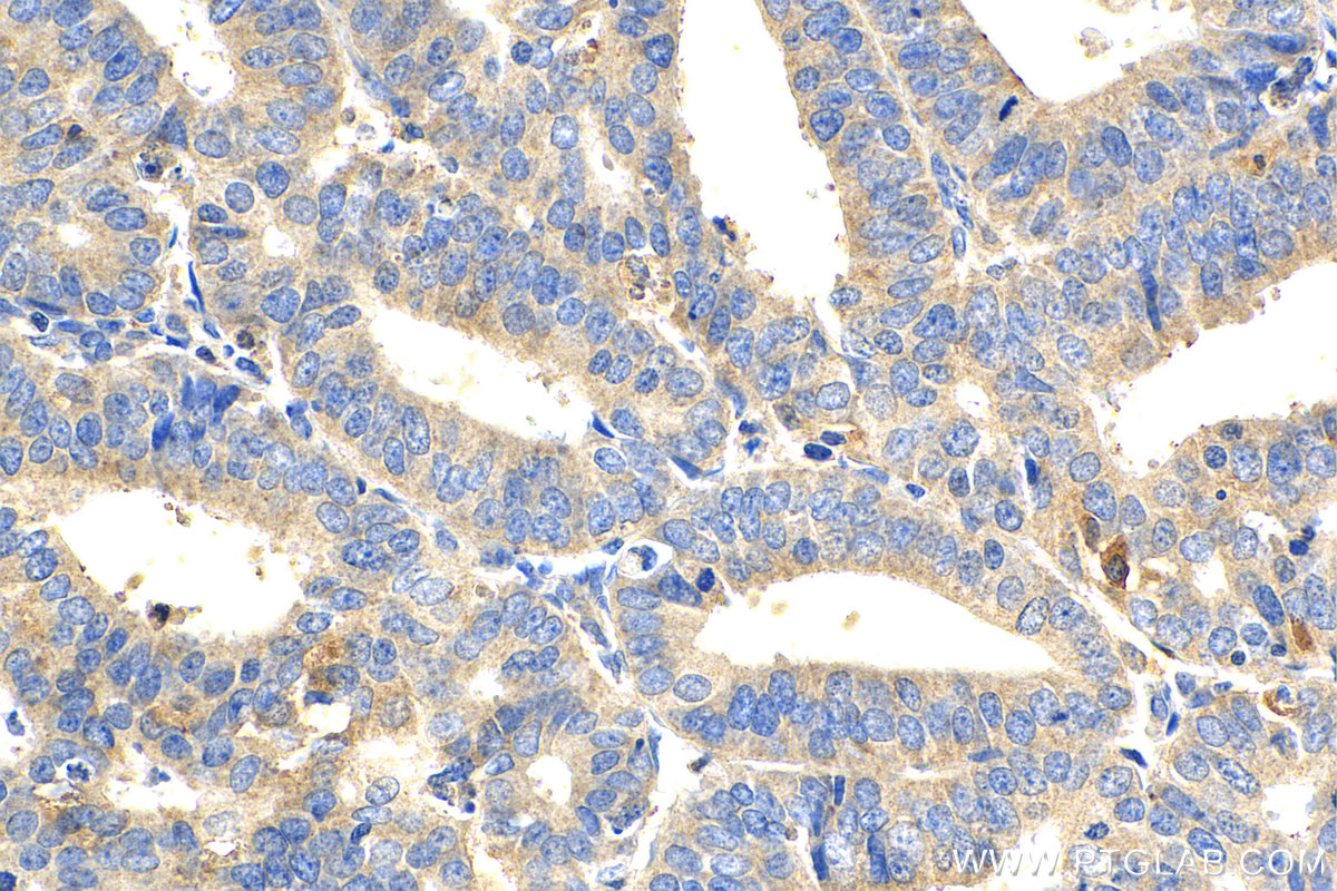 Immunohistochemistry (IHC) staining of human endometrial cancer tissue using NPSR1 Polyclonal antibody (25085-1-AP)