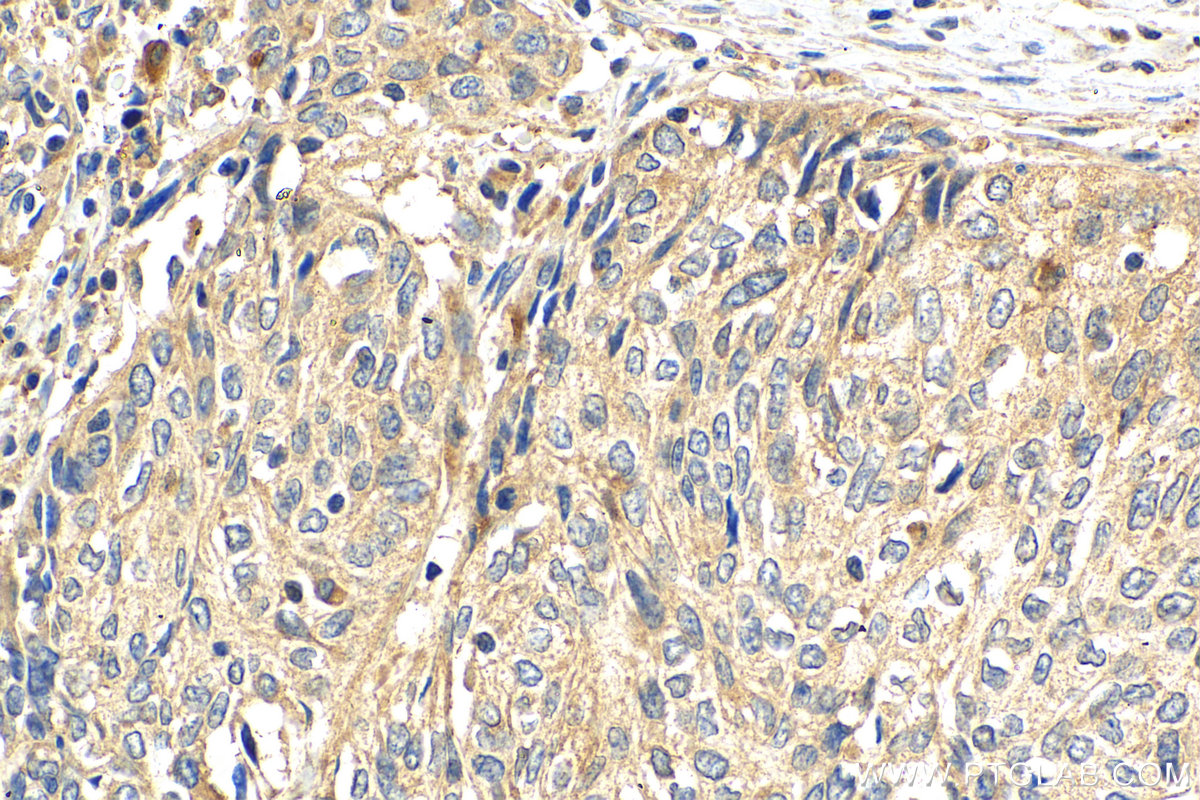 Immunohistochemistry (IHC) staining of human cervical cancer tissue using NPSR1 Polyclonal antibody (25085-1-AP)