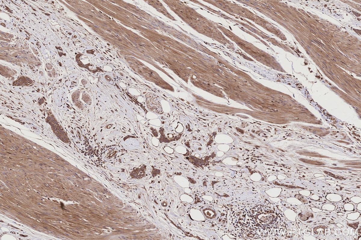 Immunohistochemistry (IHC) staining of human urothelial carcinoma tissue using NQO2 Polyclonal antibody (15767-1-AP)