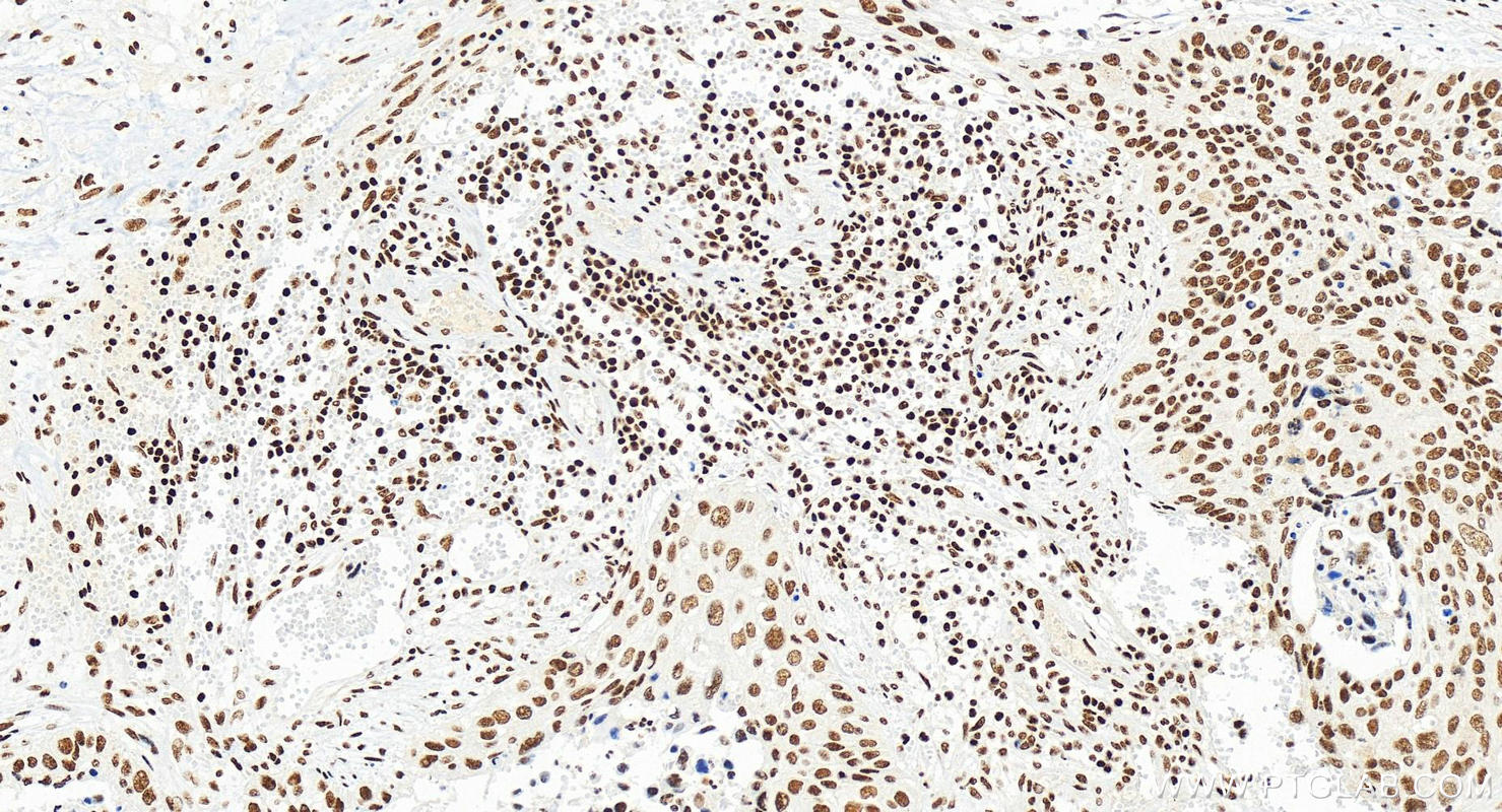 Immunohistochemistry (IHC) staining of human cervical squamous cancer tissue using NRF1/nuclear respiratory factor 1 Recombinant anti (83092-1-RR)