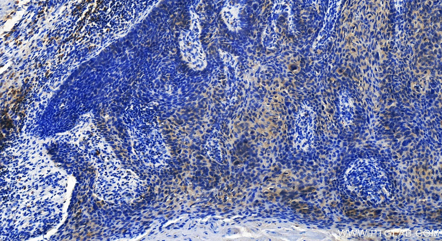 Immunohistochemistry (IHC) staining of Human bowens disease using NRF2, NFE2L2 Recombinant antibody (80593-1-RR)