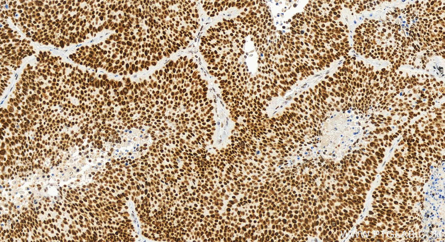 Immunohistochemistry (IHC) staining of human lung squamous cell carcinoma tissue using NSD3 Recombinant antibody (83116-1-RR)