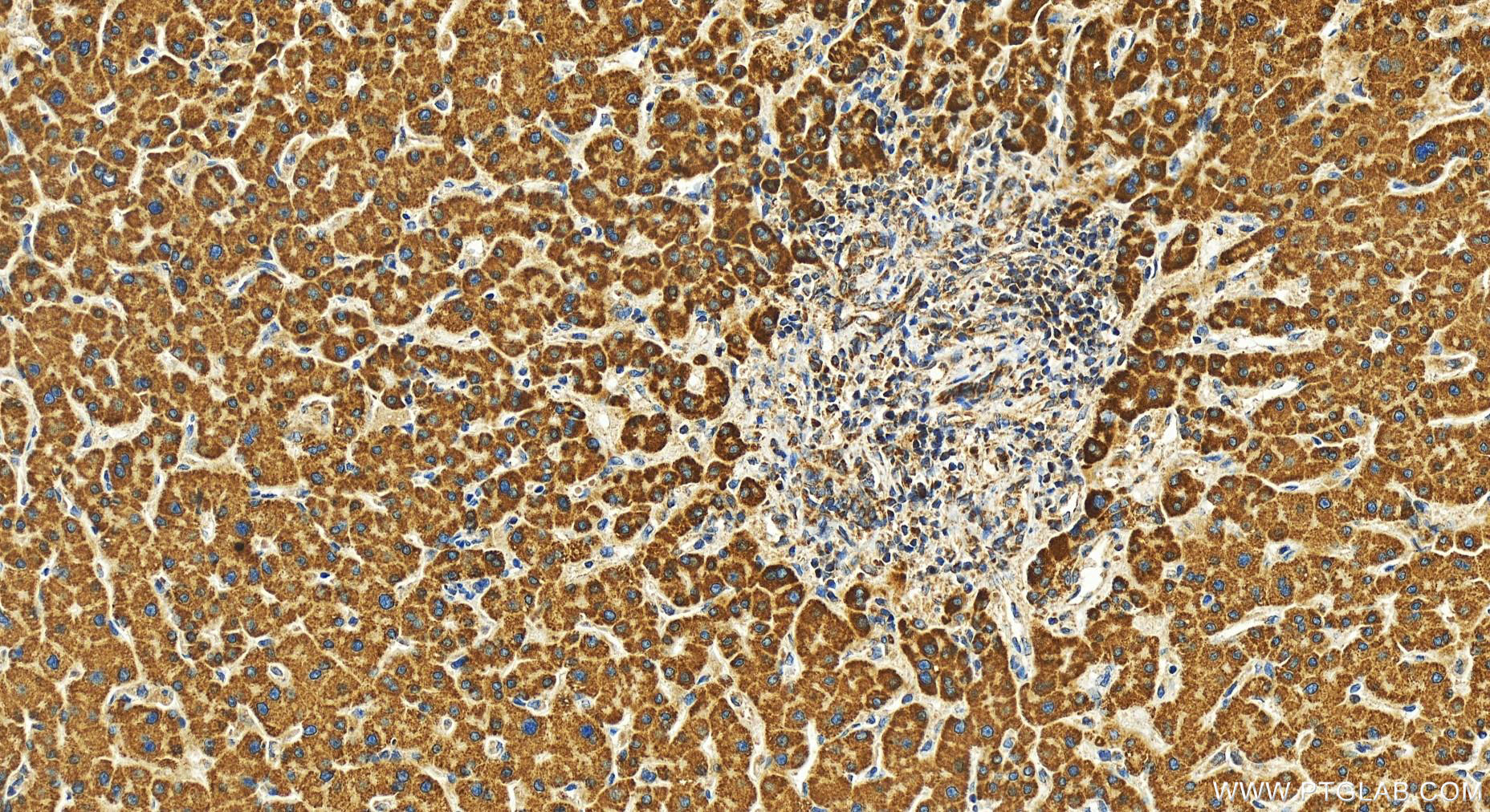 Immunohistochemistry (IHC) staining of human intrahepatic cholangiocarcinoma tissue using NSMAF Polyclonal antibody (19407-1-AP)