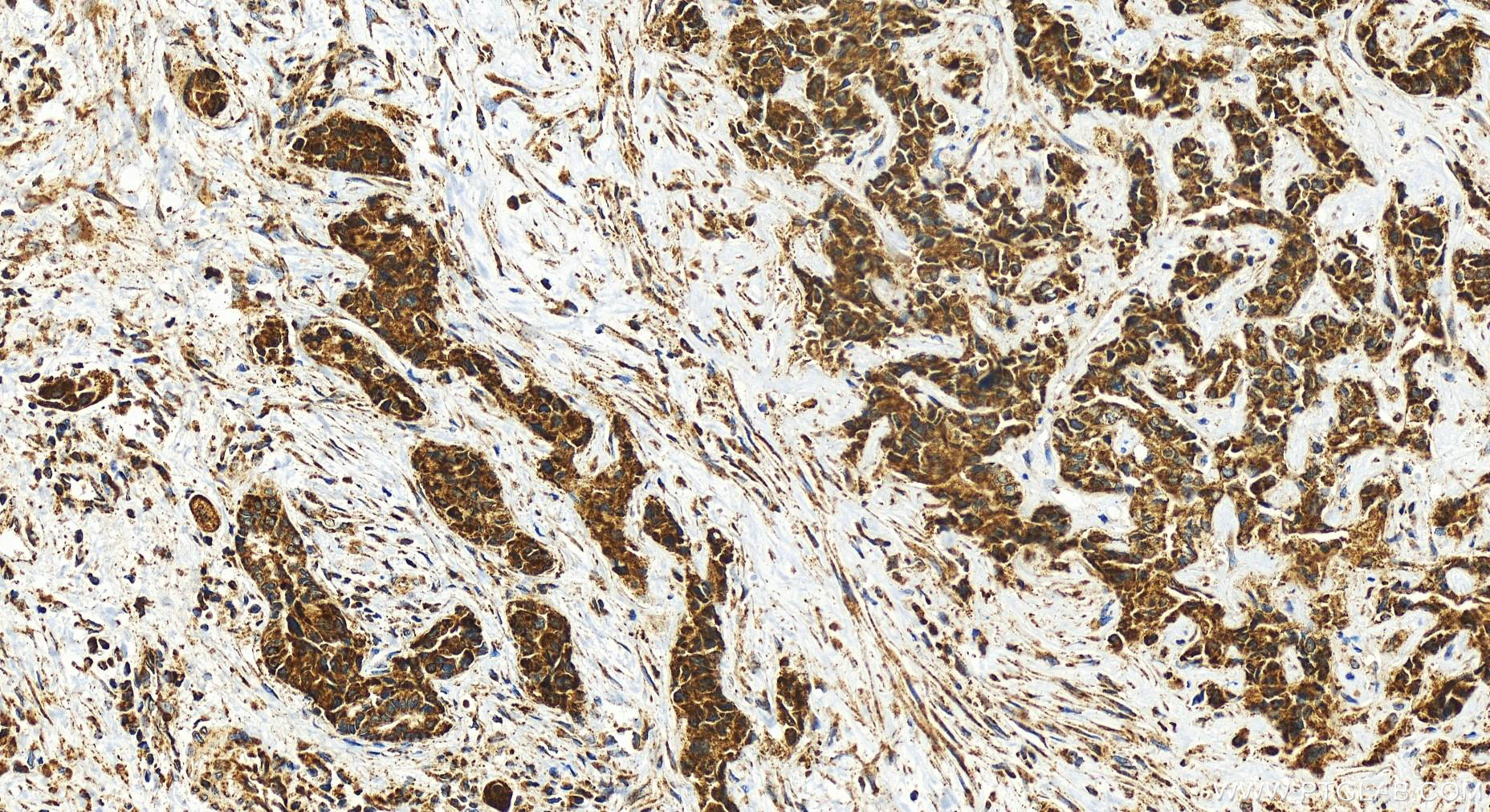 Immunohistochemistry (IHC) staining of human intrahepatic cholangiocarcinoma tissue using NSMAF Polyclonal antibody (19407-1-AP)