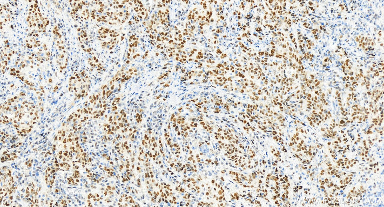 Immunohistochemistry (IHC) staining of human stomach cancer tissue using NSUN2 Recombinant antibody (82894-7-RR)