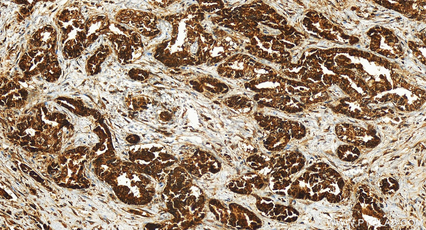 Immunohistochemistry (IHC) staining of human intrahepatic cholangiocarcinoma tissue using NSUN4 Polyclonal antibody (29786-1-AP)